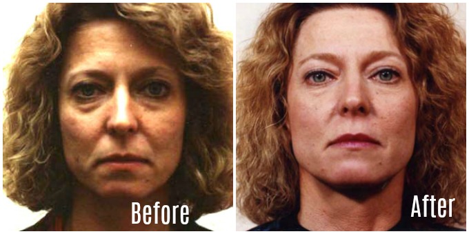Facial Magic before and after pics